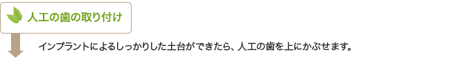 人工の歯の取り付け｜インプラントによるしっかりした土台ができたら、人工の歯を上にかぶせます。