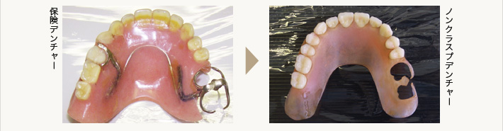 保険デンチャー→ノンクラスプデンチャー